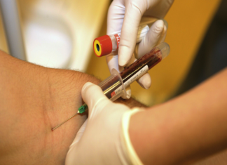Cancer : Un test sanguin pour le détecter à un stade précoce